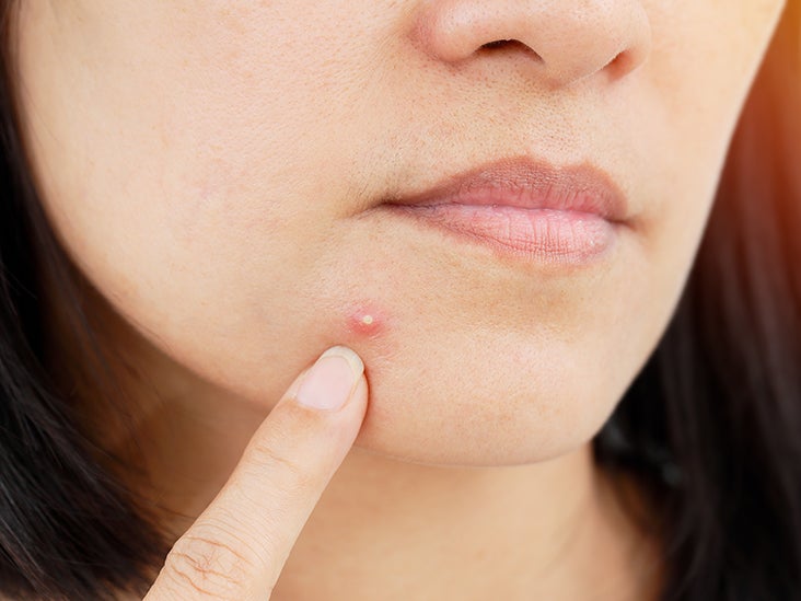 Pimples not go away: Causes treatment