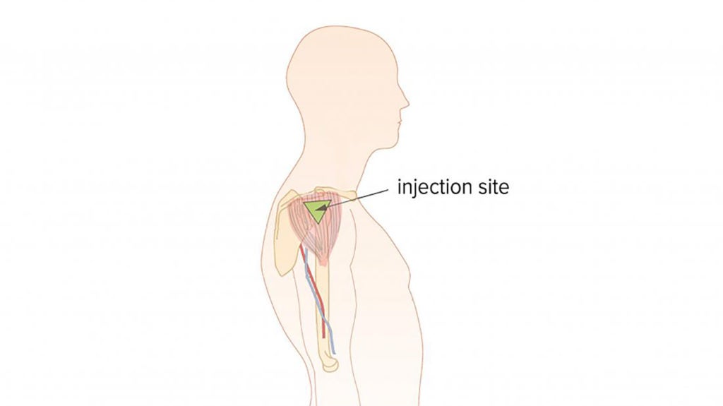 Intramuscular Injection Deltoid Br Image Credit British Columbia Institute Of Technology Bcit 2017 Br 1 1024x575 