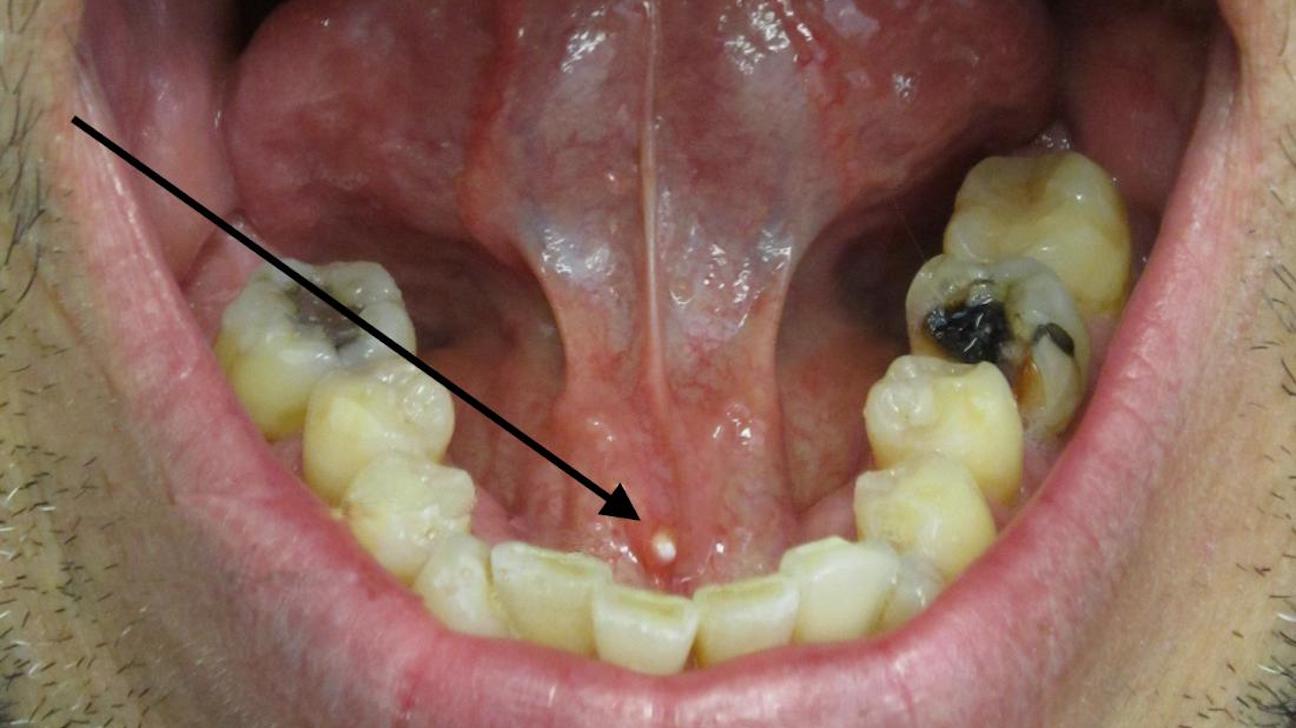 6 Causes Of Sticky Saliva & Home Remedies