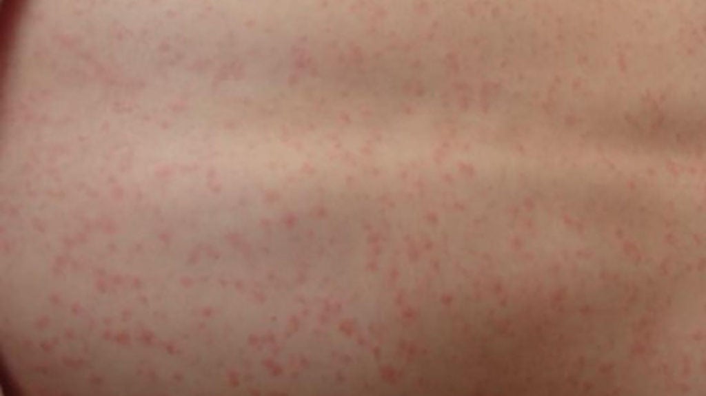 strep-a-and-scarlet-fever-information-munro-medical-centre