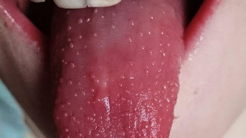 White Spots On Side Of Tongue And Sore Throat