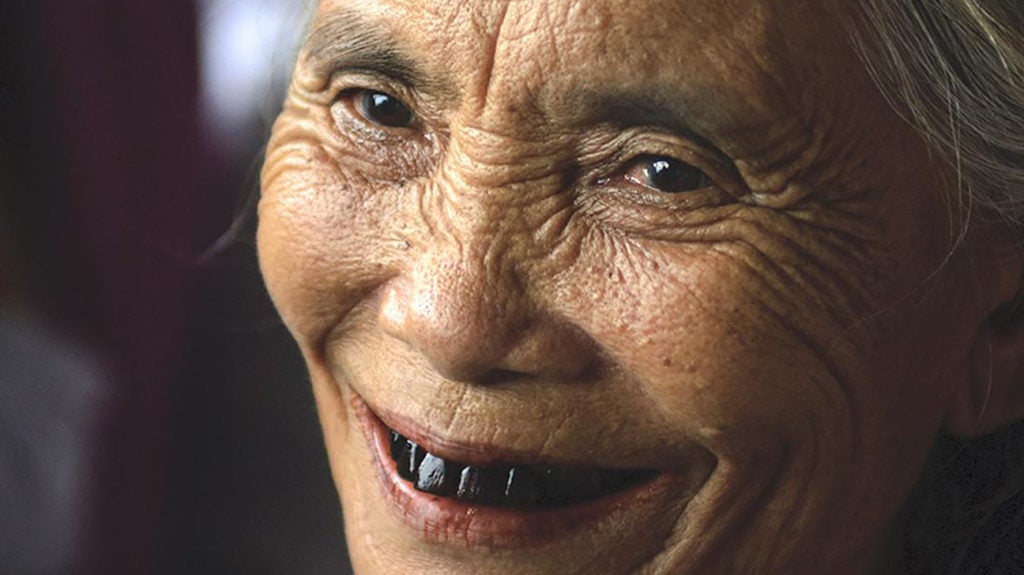 Black teeth Stains, other causes, and treatment