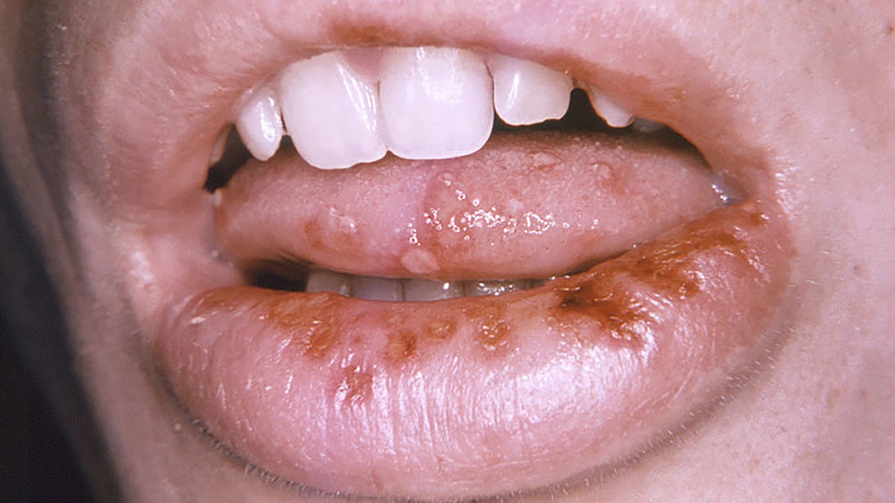 Herpes genitalis symptome