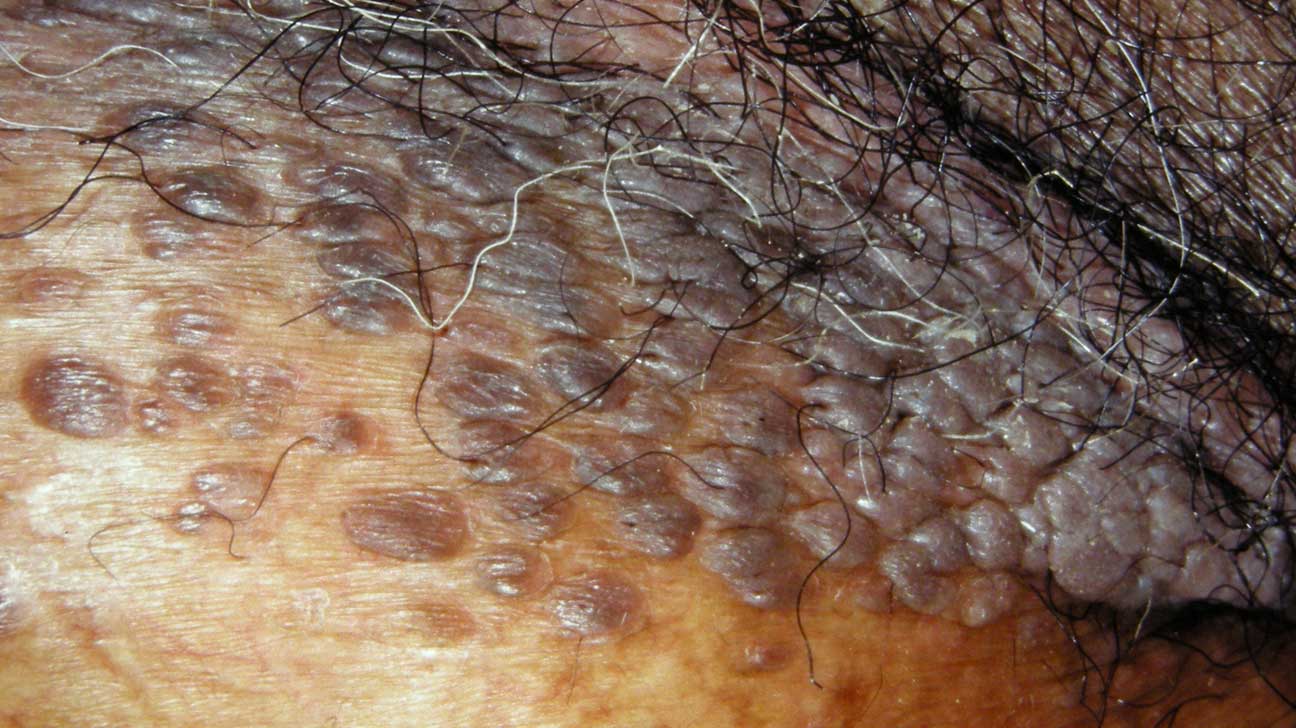 hpv wart areas