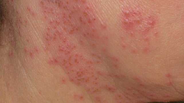 Eczema Herpeticum Symptoms Diagnosis And Treatment