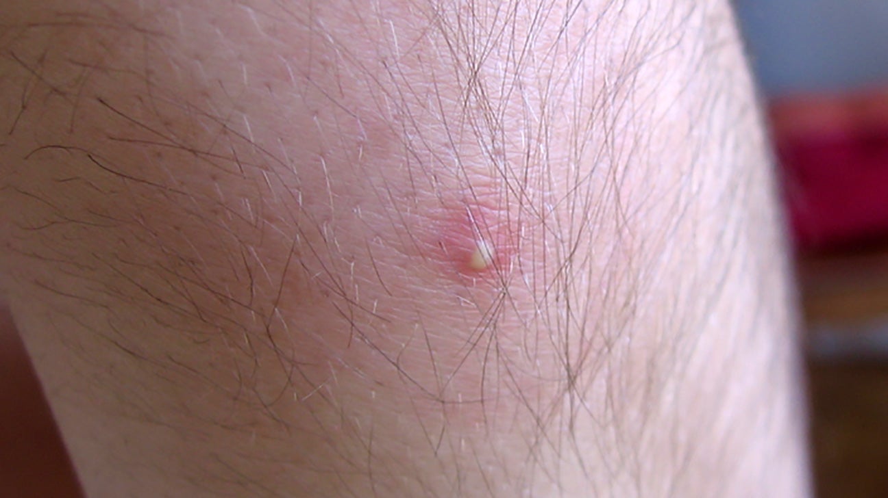 hard white bump on arm