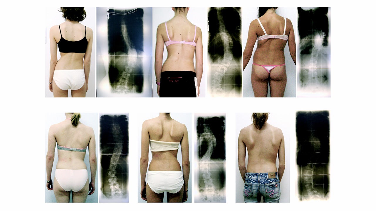 Different scoliosis patterns radiological and clinical highresolution slide