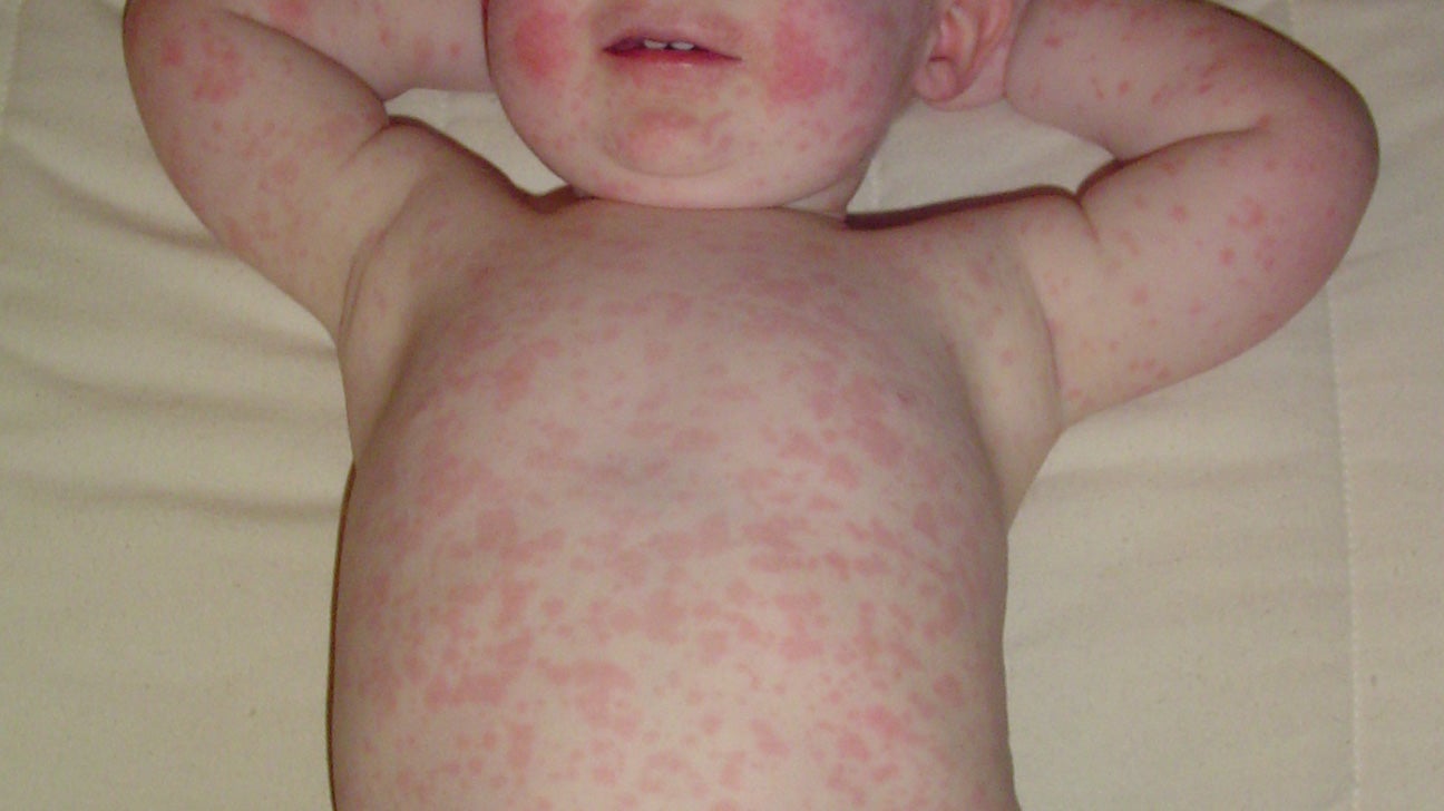 Baby rash: Causes and to a doctor