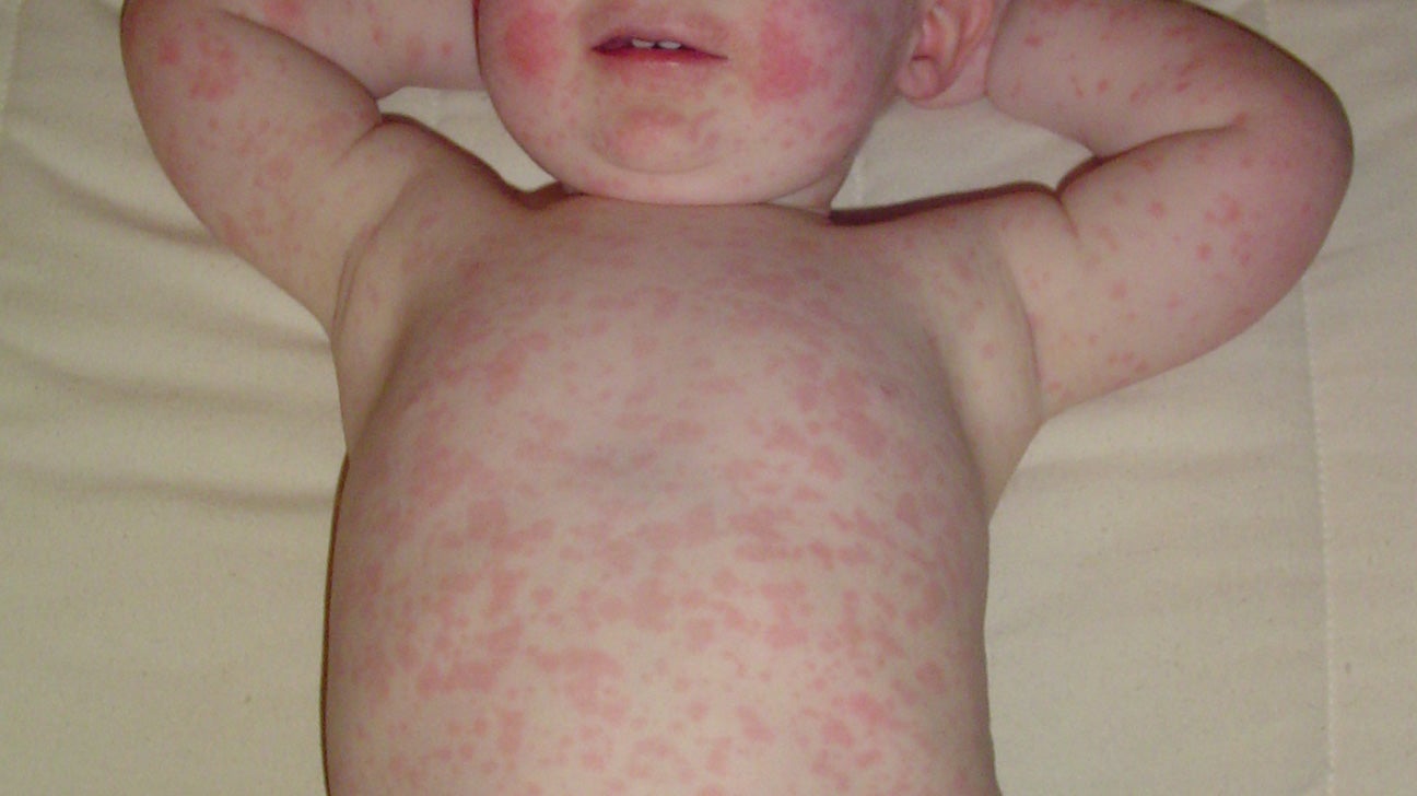 Allergy rash baby torso