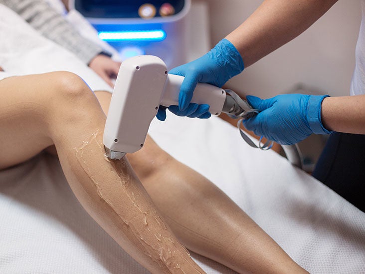 Laser hair removal side effects: Is it safe, is it painful, and more