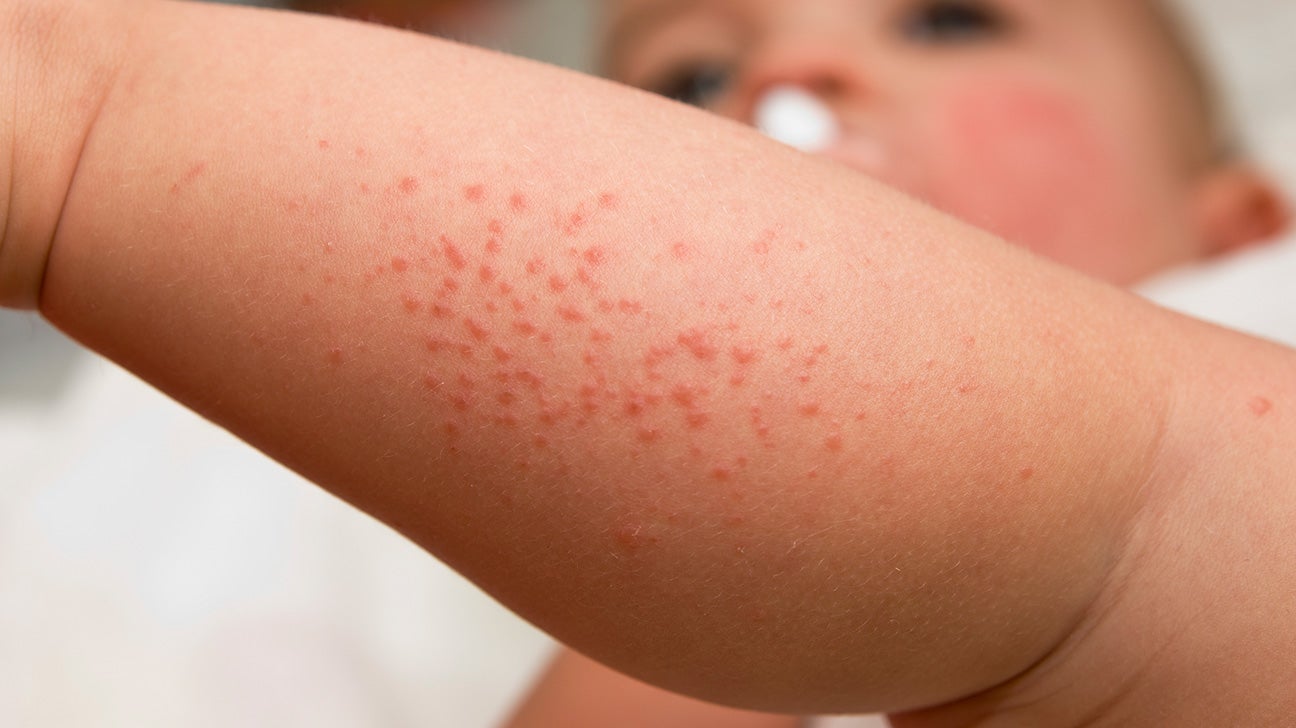 Red itchy rash on baby neck