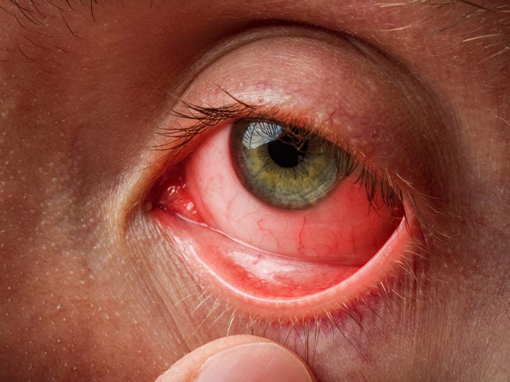 eye: Causes, symptoms, pictures, and treatment