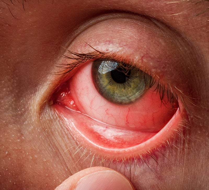 Infected eye: Causes, pictures, and