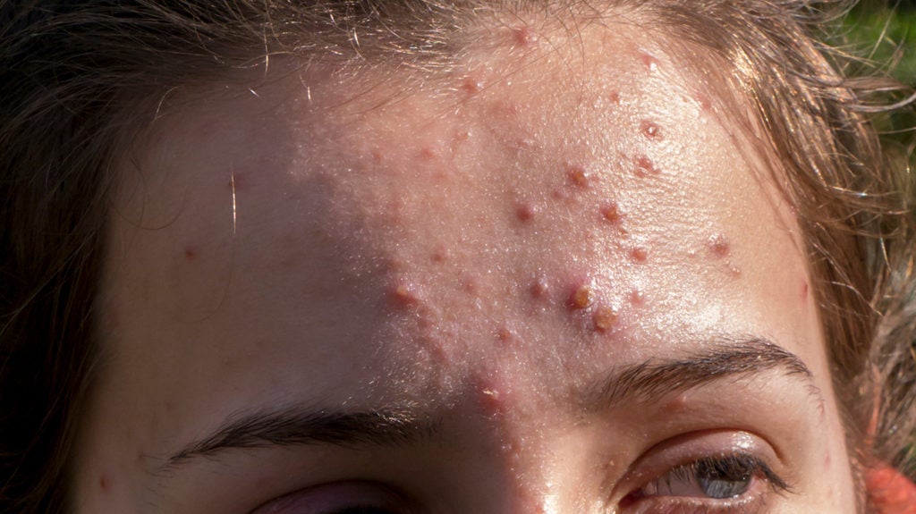 Inflamed Acne Treatments And Prevention