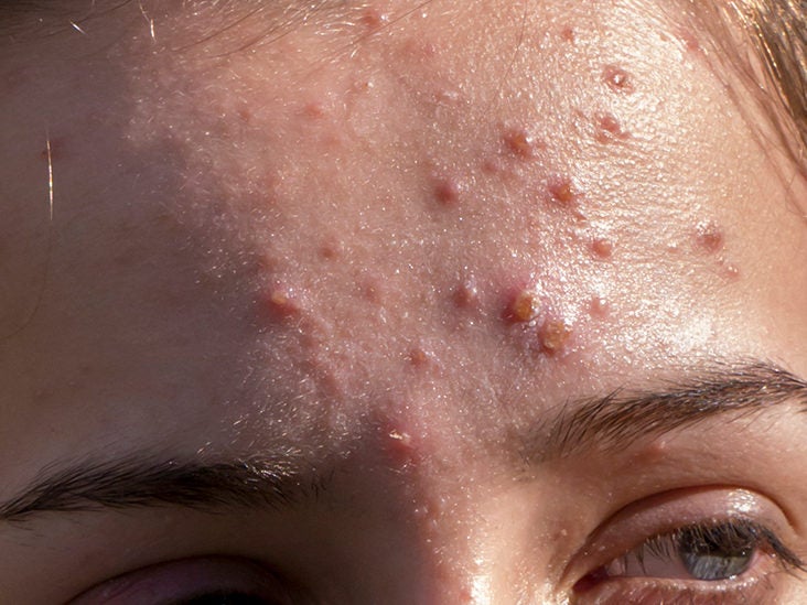 Cystic acne: Causes, symptoms, and treatments