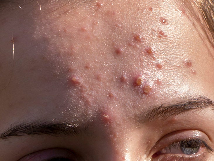 acne: Treatments and prevention