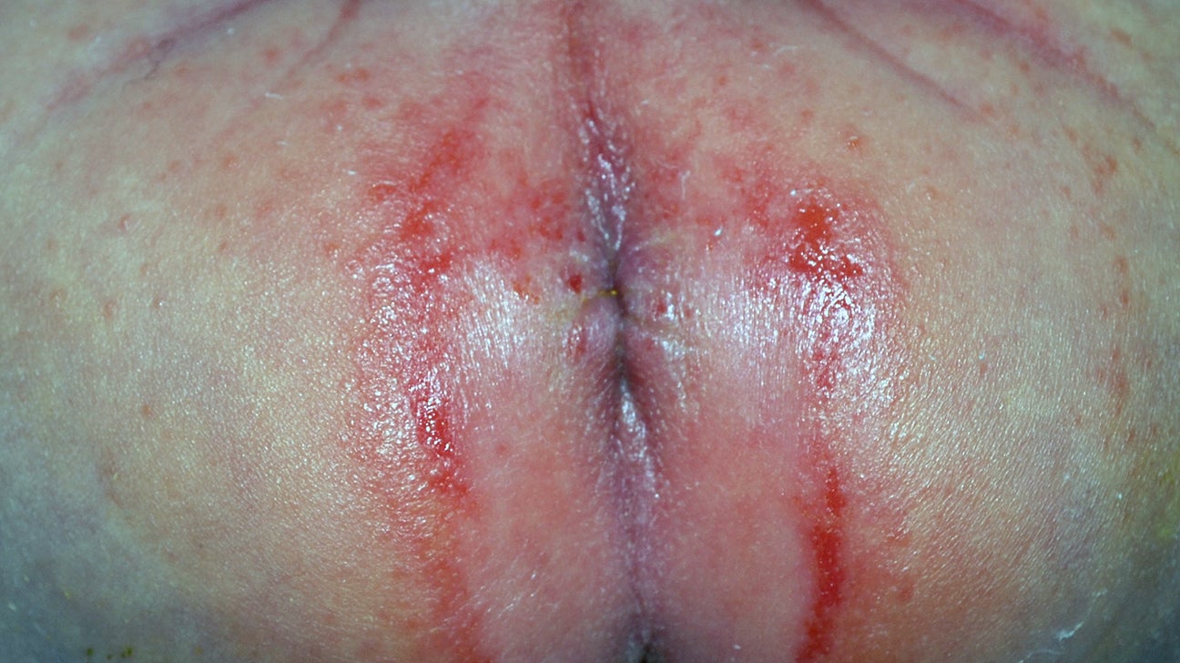 severe diaper rash bleeding