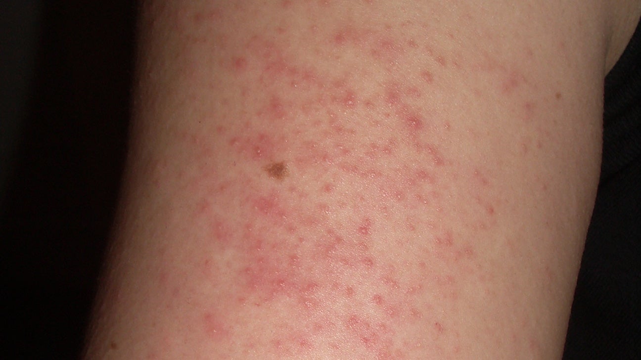 rashes on arms