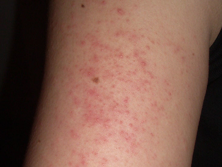 Bumps on arms: Causes and treatment