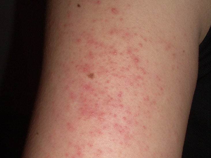 skin diseases on arms