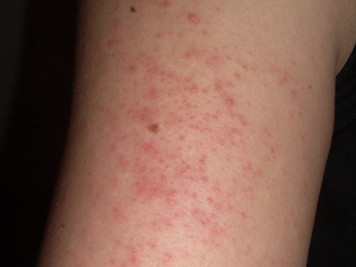 itchy bumps on my arm