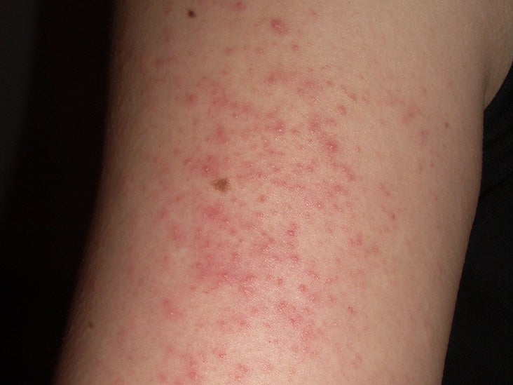 bumps-on-arms-causes-and-treatment