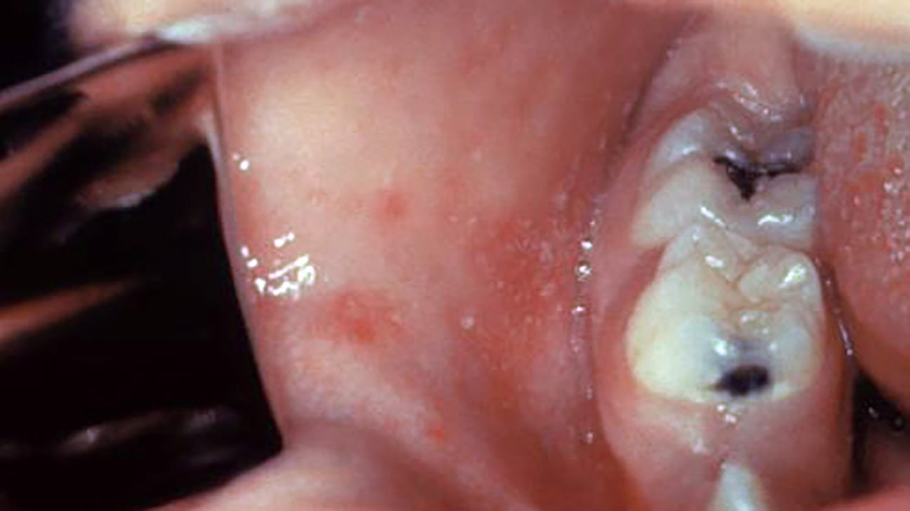 Measles Causes