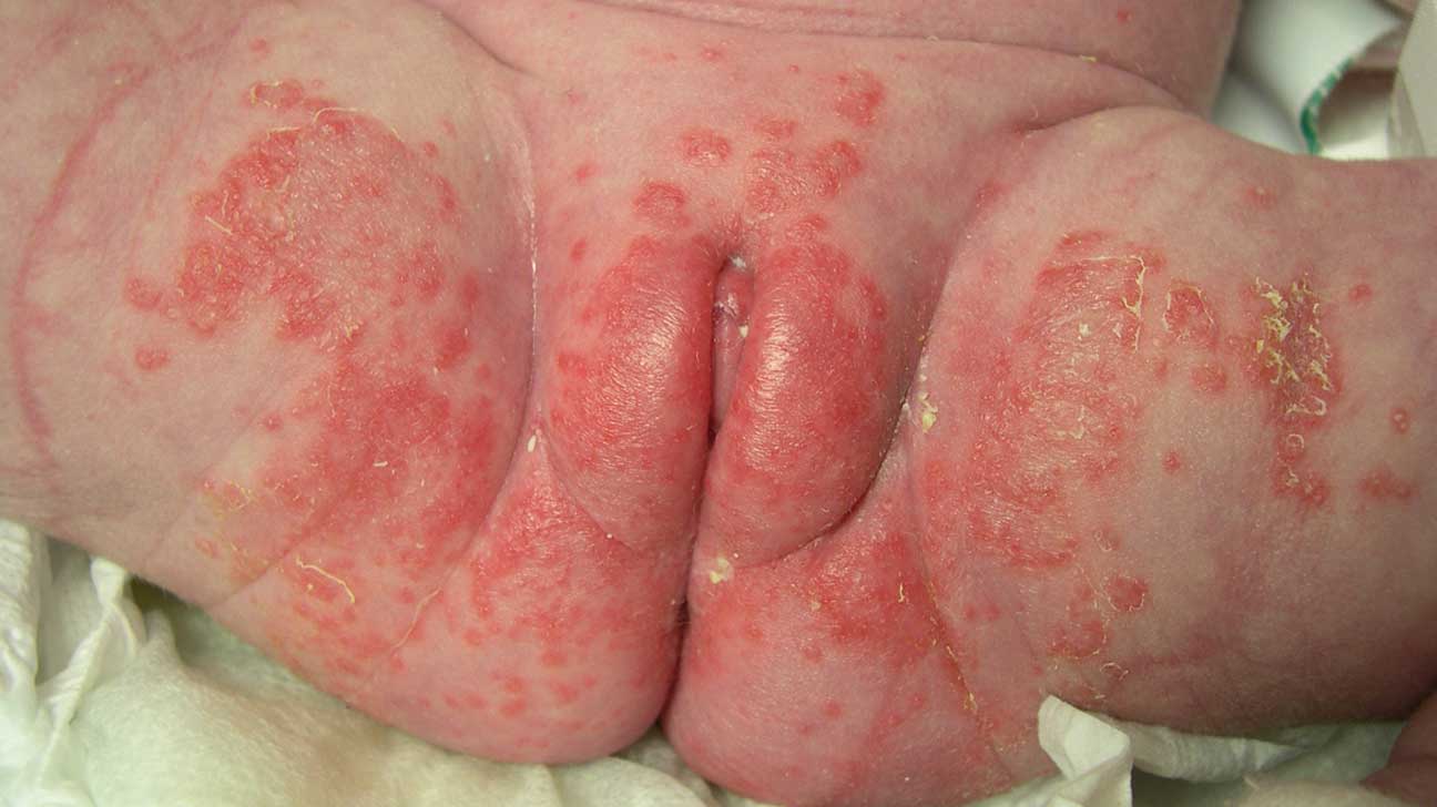 thrush rash
