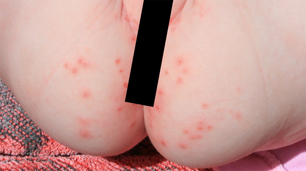 staph infection diaper rash