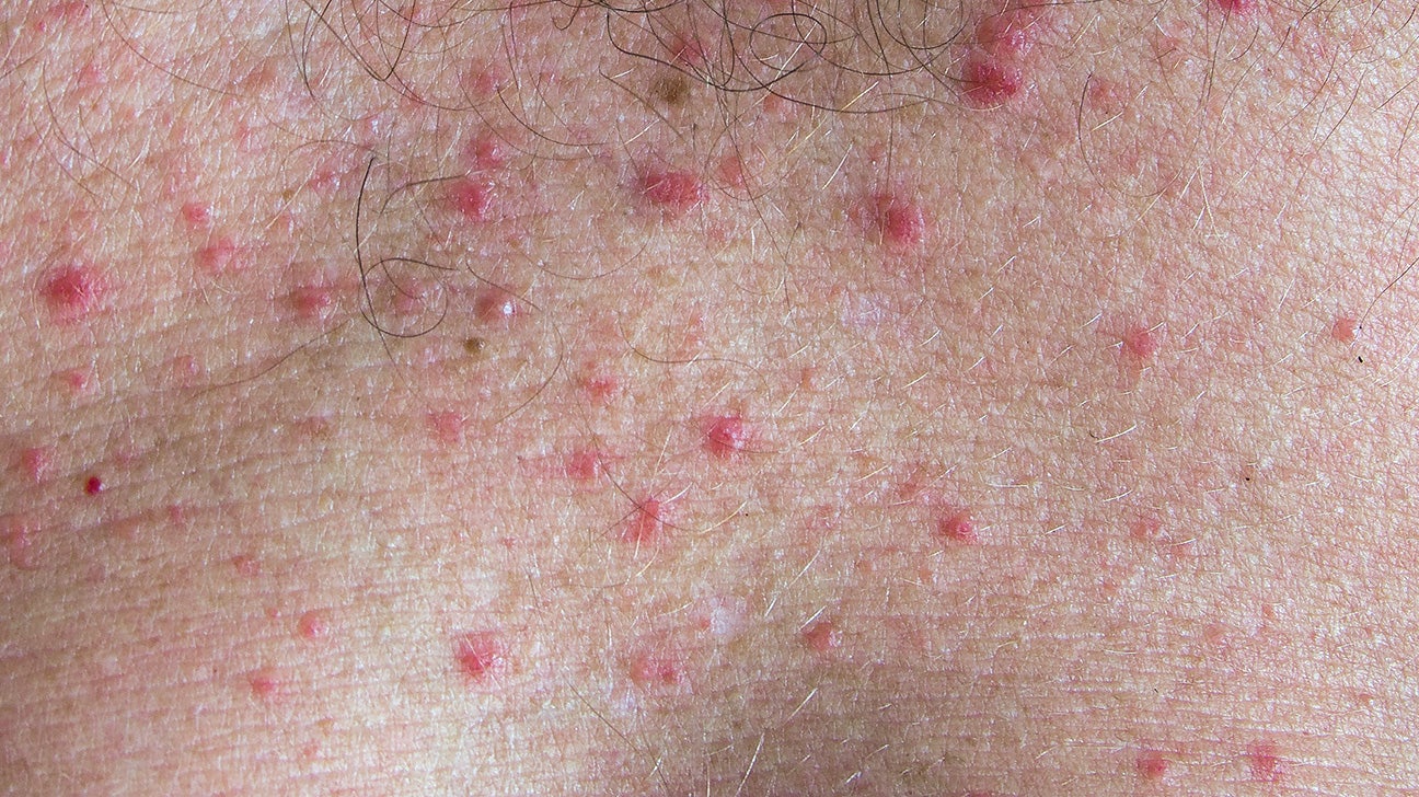 itchy bumps on my arm