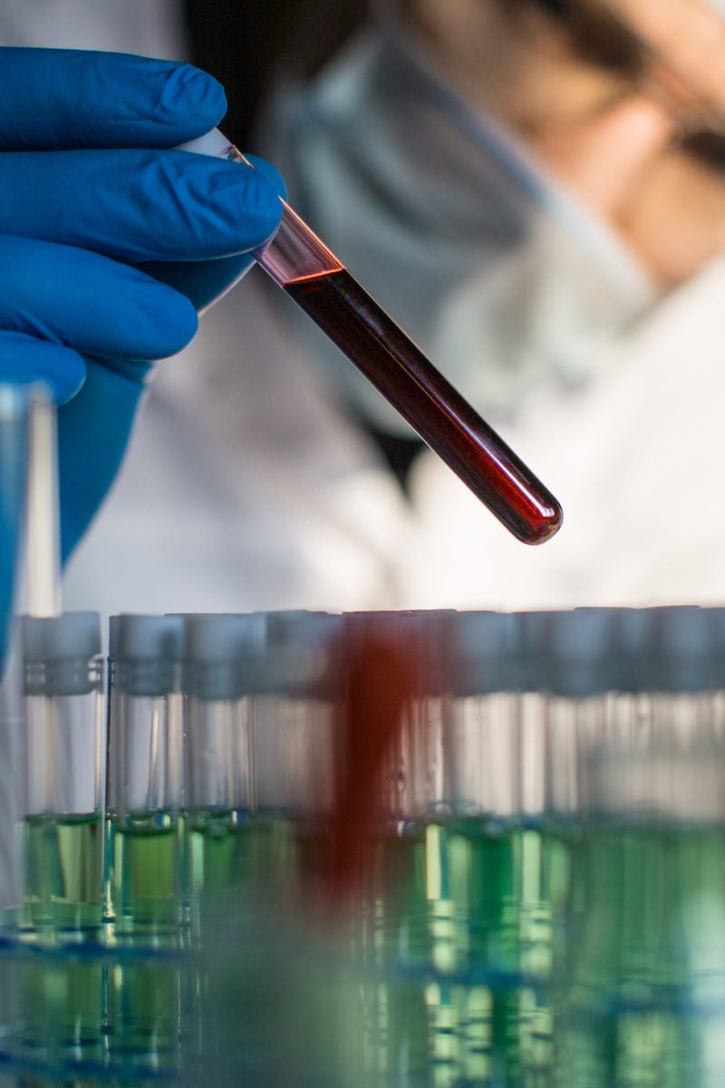 What Blood Test Can Detect Dementia