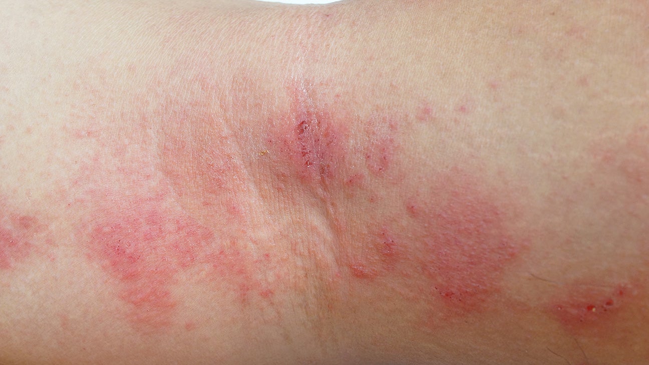 red bumps on arms not itchy