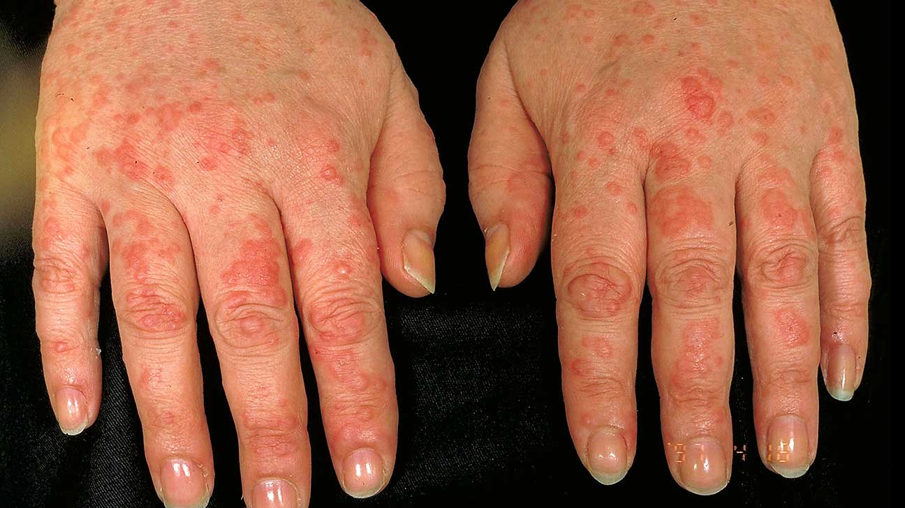 Allergic reaction on hands treatment