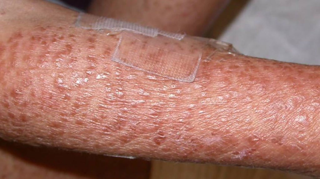 Blau syndrome Definition, symptoms, and treatment