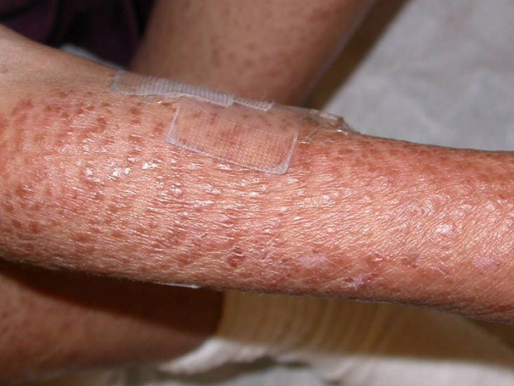 skive chance miles List of rare skin diseases: Pictures, symptoms, and treatments
