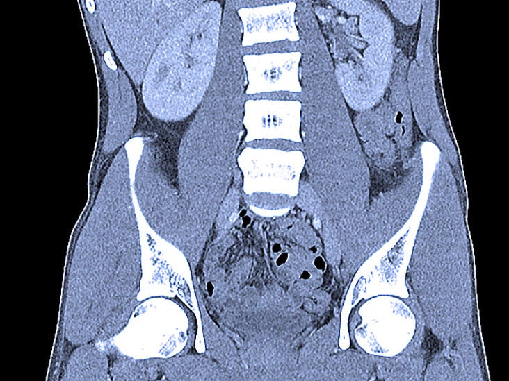 Computerized tomography (CT) urogram