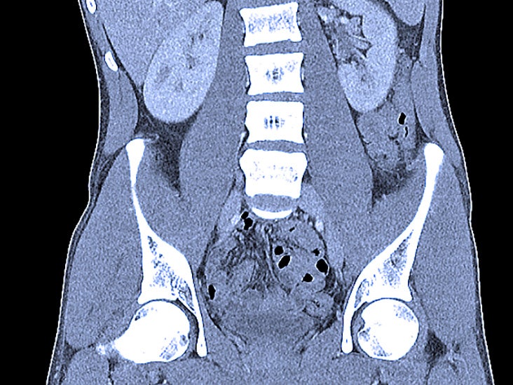 Ct Scan Images Of The Abdomen And Pelvis Ct Scan Abdomen And Pelvis ...