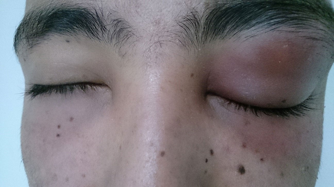 Swollen and Puffy Eyes (Bags Under Eyes)