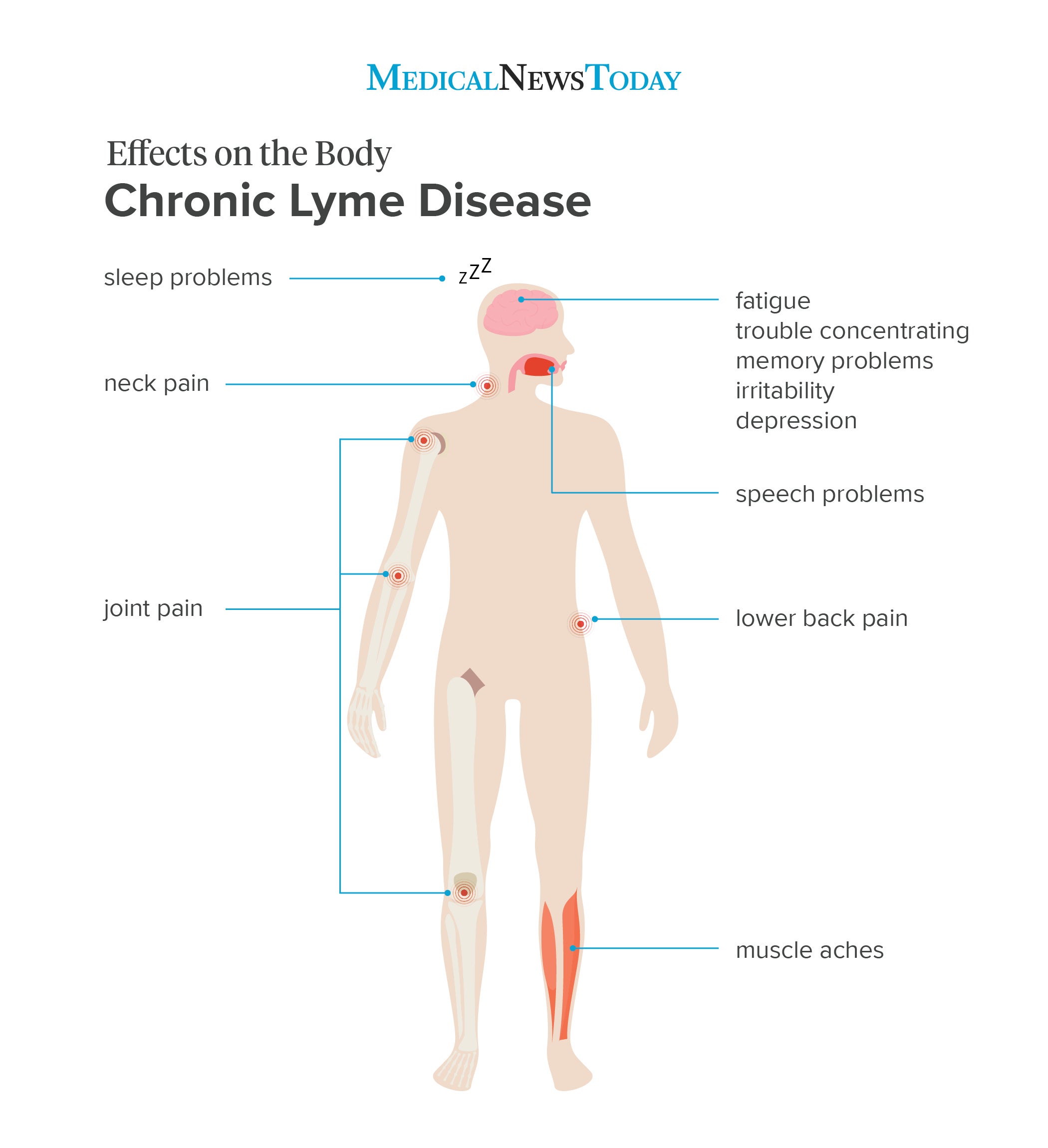 Lyme disease symptoms Progression and when to see a doctor