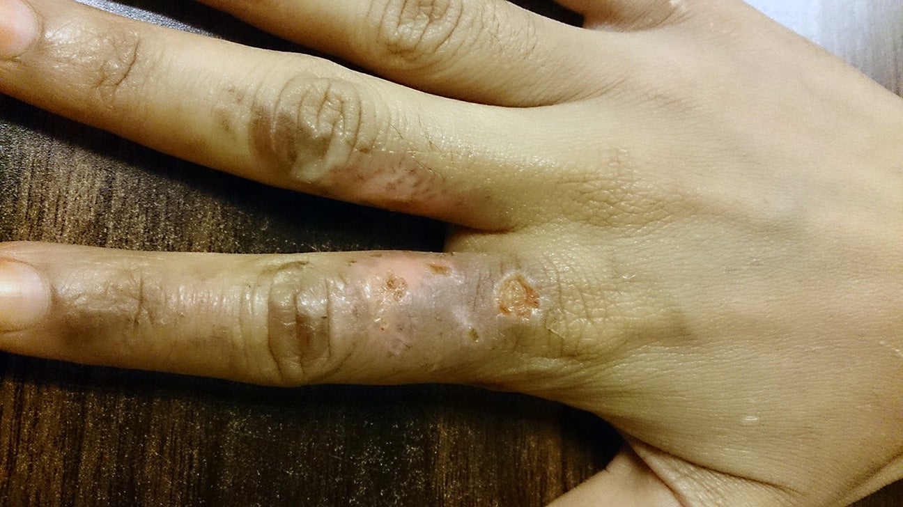 3rd degree burn scar hand