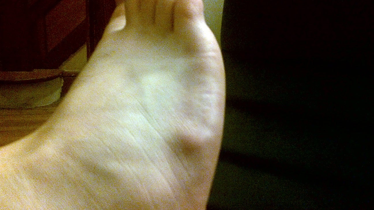 spur on side of foot