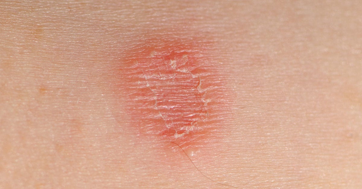 skin-lesions-pictures-treatments-and-causes