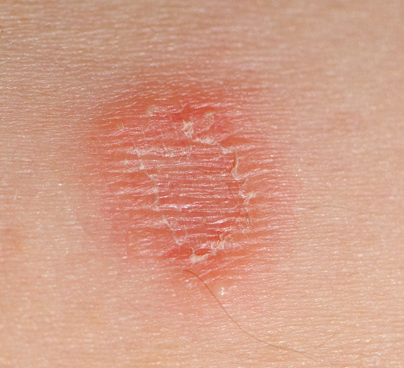 Skin Lesions Pictures Causes Types Risks Diagnosis And Treatments