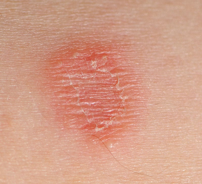 Skin lesions: Pictures, treatments, and causes