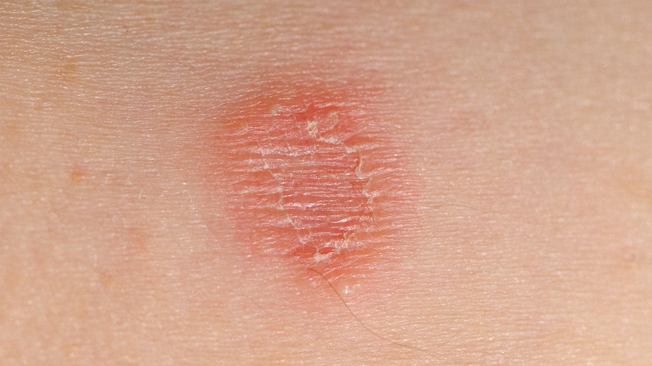 Skin lesions: Pictures, treatments, and causes