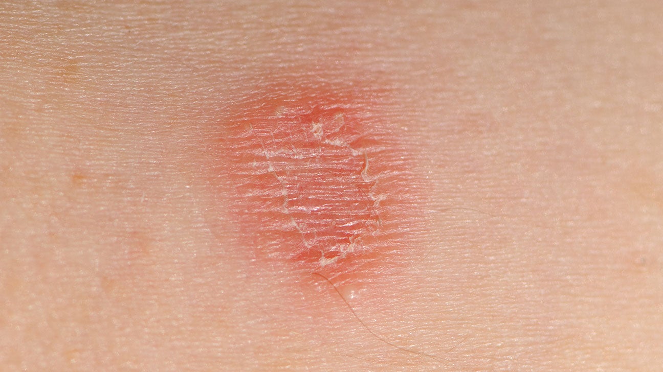 Skin Lesions: Pictures, Causes, Diagnosis, Treatment More, 45% OFF