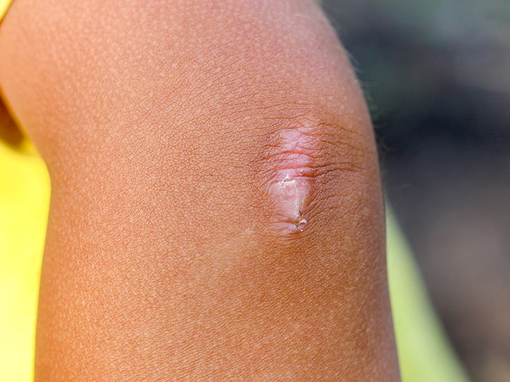 Scar Tissue Pain What It Feels Like Why It Happens And Treatment