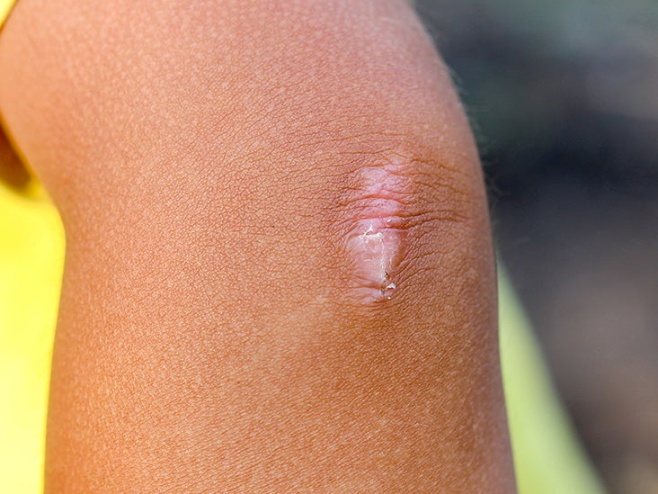 Scar Tissue and Adhesion Treatment