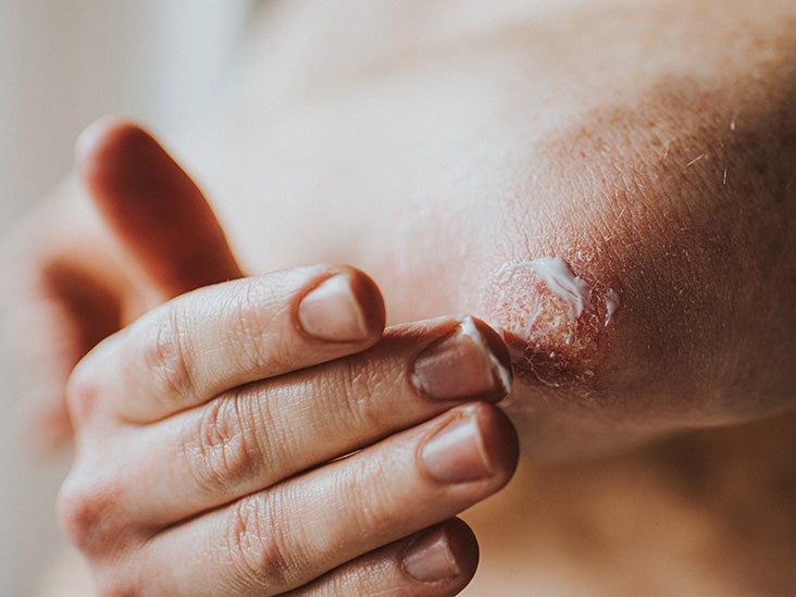 How Does Smoking Affect Psoriasis?