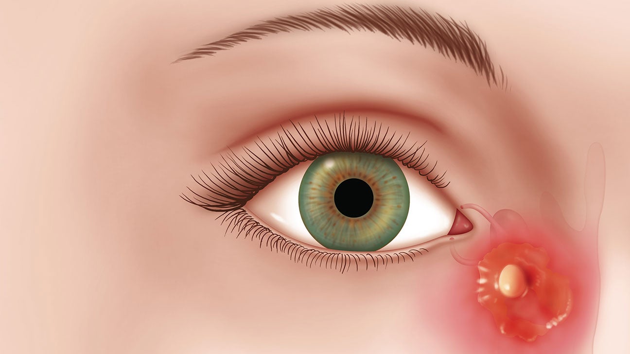 Causes, Symptoms and Treatments For Puffy Eyes